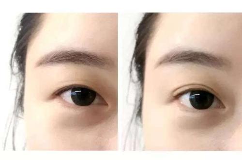 肿眼泡适合选择哪种<a href=http://www.mx185.com/listinfo-724-0.html target=_blank class=infotextkey>双眼皮</a>贴？