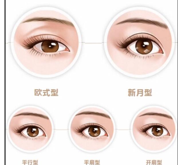 不同眼形适合不同重睑术