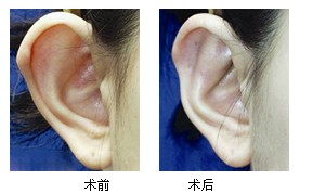 招风耳整形一般是多少岁动手术比较好