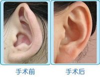 解析招风耳整形过程