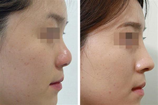 韩式<a href=http://www.mx185.com/listinfo-737-0.html target=_blank class=infotextkey>隆鼻</a>前后对比图