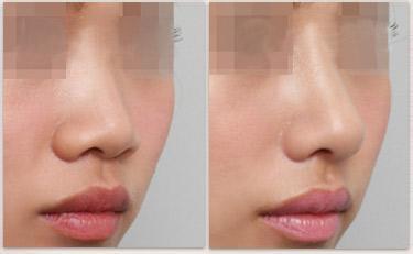 韩式<a href=http://www.mx185.com/listinfo-737-0.html target=_blank class=infotextkey>隆鼻</a>和鼻部多项区别