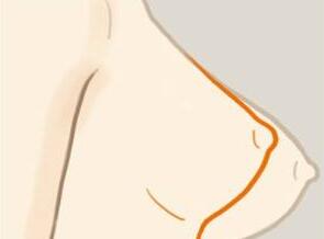 <a href=http://www.mx185.com/listinfo-617-0.html target=_blank class=infotextkey>巨乳缩小</a>整形术后注意事项