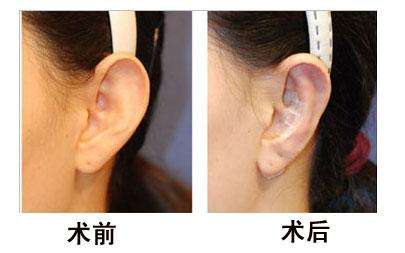 哪些人适合<a href=http://www.mx185.com/listinfo-698-0.html target=_blank class=infotextkey>招风耳矫正</a>手术？