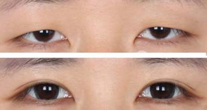 上眼睑下垂手术费用