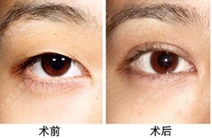 做<a href=http://www.mx185.com/listinfo-724-0.html target=_blank class=infotextkey>双眼皮</a>手术有后遗症吗