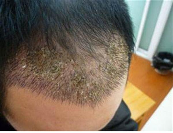 南京头发种植的价格