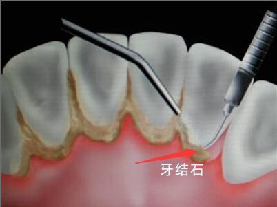 牙石有什么危害