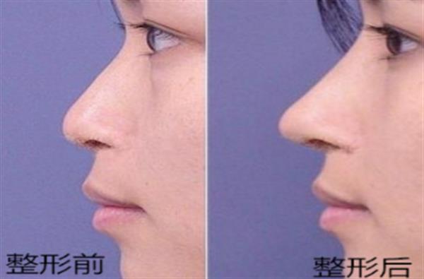 透明质酸<a href=http://www.mx185.com/listinfo-737-0.html target=_blank class=infotextkey>隆鼻</a>前后恢复对比图