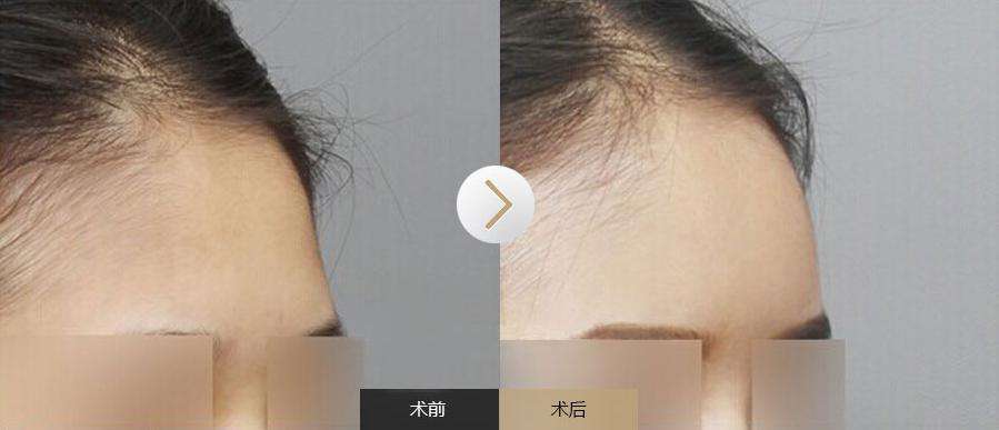 自体脂肪<a href=http://www.mx185.com/listinfo-630-0.html target=_blank class=infotextkey>丰太阳穴</a>前后对比