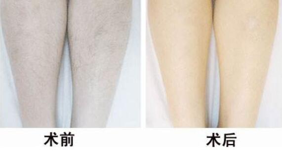 冰点<a href=http://www.mx185.com/listinfo-670-0.html target=_blank class=infotextkey>脱毛</a>后的注意事项