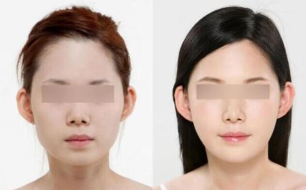 鼻翼肥大怎么变小？多少钱呢？