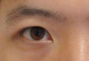 做个黑眼圈手术多少钱