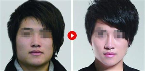男生下颚骨整形后遗症?