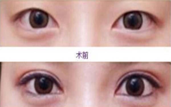 埋线<a href=http://www.mx185.com/listinfo-724-0.html target=_blank class=infotextkey>双眼皮</a>拆线多少钱