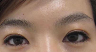 埋线<a href=http://www.mx185.com/listinfo-724-0.html target=_blank class=infotextkey>双眼皮</a>宽能改窄吗
