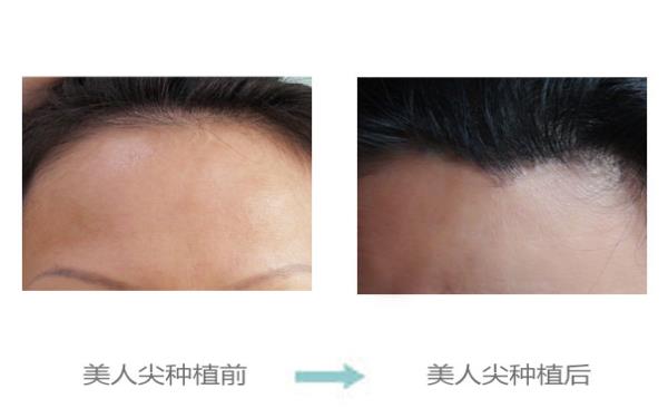 <a href=http://www.mx185.com/listinfo-669-0.html target=_blank class=infotextkey>美人尖种植</a>的效果及安全性