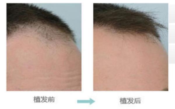 美容尖种植术的价格及效果