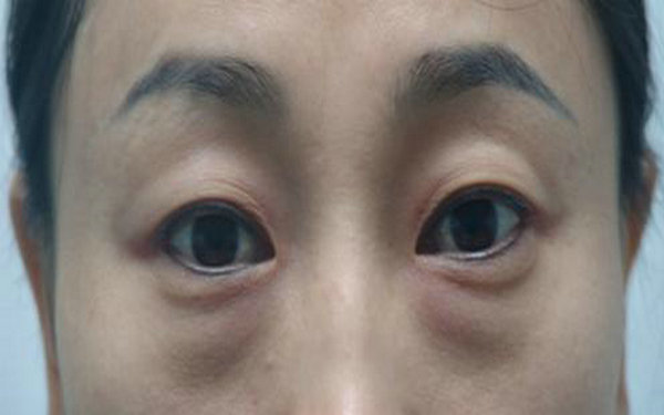 内切<a href=http://www.mx185.com/listinfo-708-0.html target=_blank class=infotextkey>去眼袋</a>费用