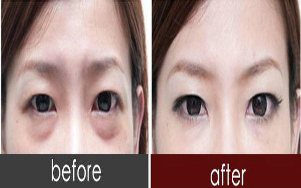 内切<a href=http://www.mx185.com/listinfo-708-0.html target=_blank class=infotextkey>去眼袋</a>能保持几年?
