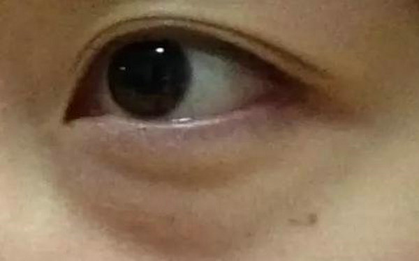 内切眼袋很容易凹陷吗?
