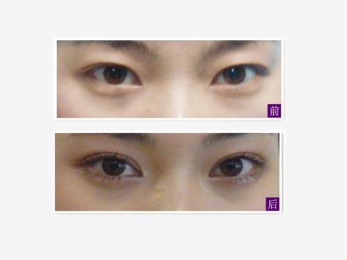 男生做<a href=http://www.mx185.com/listinfo-724-0.html target=_blank class=infotextkey>双眼皮</a>后好帅