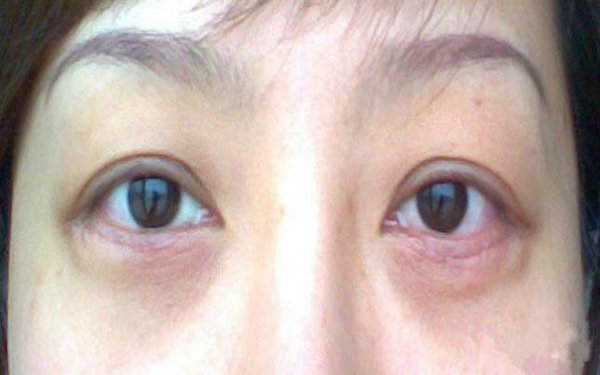 内切眼袋伤口多久愈合?