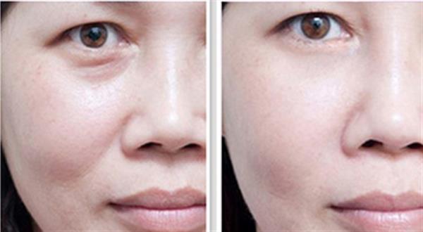 抽脂法<a href=http://www.mx185.com/listinfo-708-0.html target=_blank class=infotextkey>去眼袋</a>能维持多久