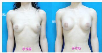 丰胸术需要多长时间