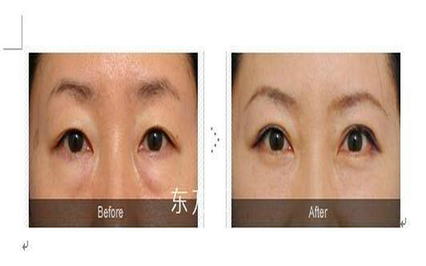 内切做眼袋多久能恢复?