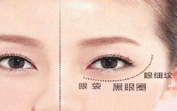 内吸祛眼袋多久能上班?
