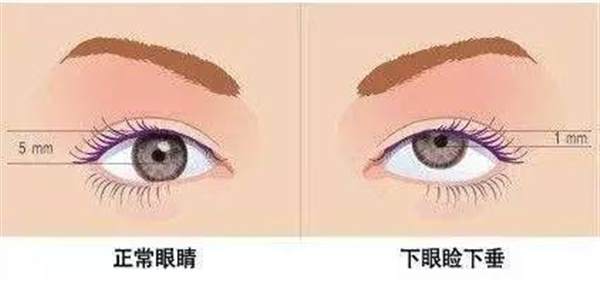 眼皮下垂做什么手术好