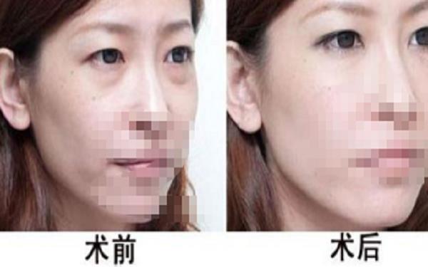 内吸眼袋后多久能洗脸?