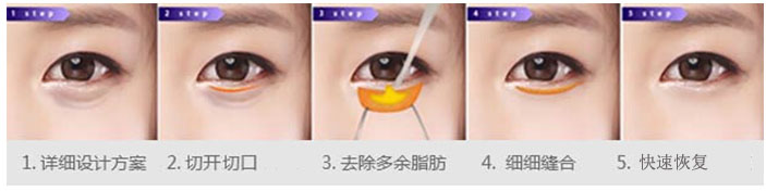 南京祛除眼袋有什么快速的方式?