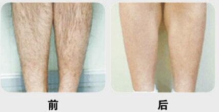 腿部激光<a href=http://www.mx185.com/listinfo-670-0.html target=_blank class=infotextkey>脱毛</a>多少钱