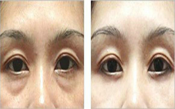 切眼袋的后遗症