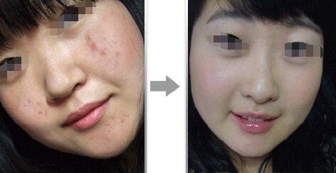 医院祛痘多少钱