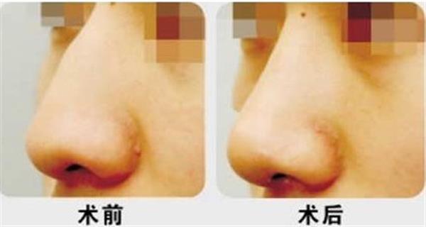 驼峰鼻矫正手术禁忌人群