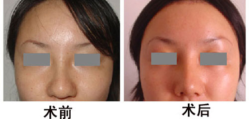 <a href=http://www.mx185.com/listinfo-754-0.html target=_blank class=infotextkey>鼻翼</a>缩小手术后恢复要多久