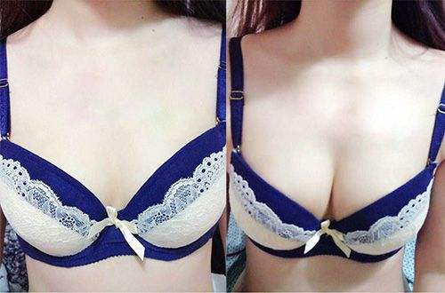 硅胶假体<a href=http://www.mx185.com/listinfo-618-0.html target=_blank class=infotextkey>隆胸</a>有哪些特点