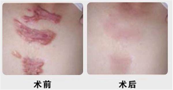 去除手术疤痕的方法