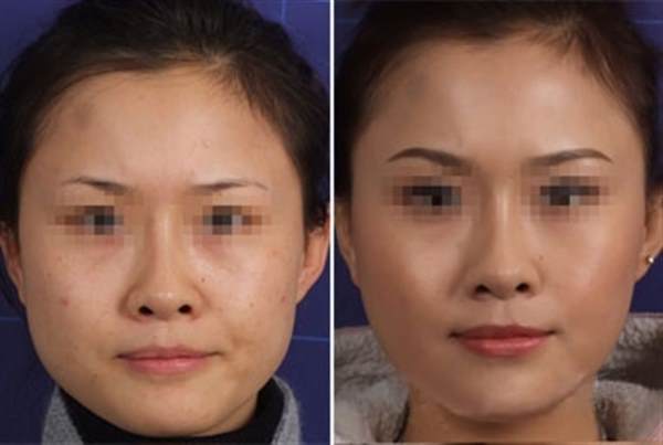 瓜子脸手术多少钱