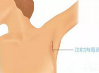 腋下<a href=http://www.mx185.com/listinfo-614-0.html target=_blank class=infotextkey>除皱</a>瘦型素注射后的注意事项
