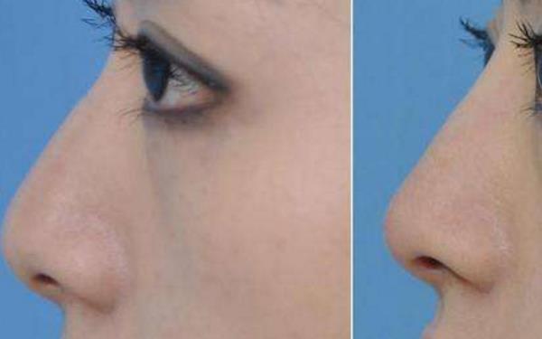 自体肋骨<a href=http://www.mx185.com/listinfo-737-0.html target=_blank class=infotextkey>隆鼻</a>保持多久