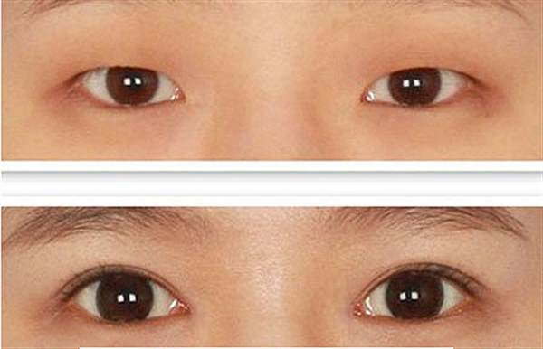 做<a href=http://www.mx185.com/listinfo-724-0.html target=_blank class=infotextkey>双眼皮</a>10年后后遗症