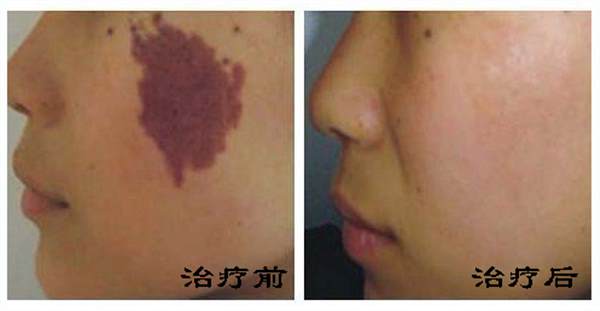 <a href=http://www.mx185.com/listinfo-773-0.html target=_blank class=infotextkey>去胎记</a>多少钱