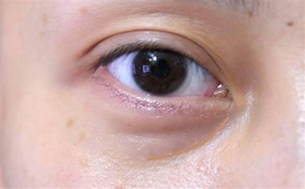 去除眼袋手术价格