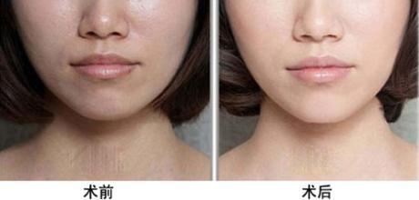 光子<a href=http://www.mx185.com/listinfo-770-0.html target=_blank class=infotextkey>嫩肤</a>之后注意事项