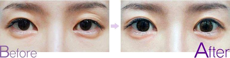 <a href=http://www.mx185.com/listinfo-711-0.html target=_blank class=infotextkey>开眼角</a>手术大概多少钱