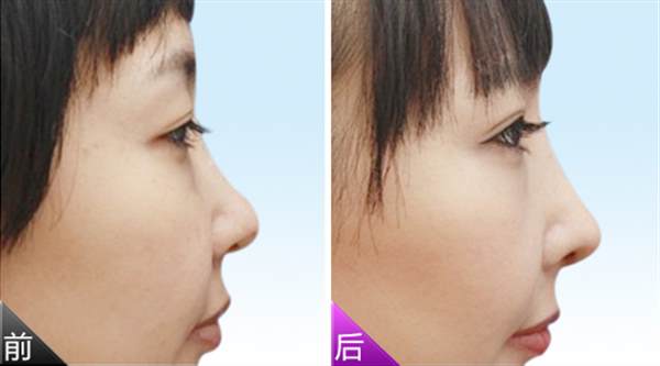膨体<a href=http://www.mx185.com/listinfo-737-0.html target=_blank class=infotextkey>隆鼻</a>手术多少价格